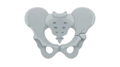 Pelvic and Acetabular Fractures
