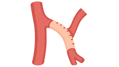 Bypass grafting techniques and materials