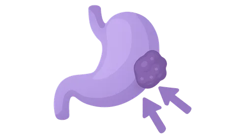 Neoadjuvant and adjuvant therapy timing