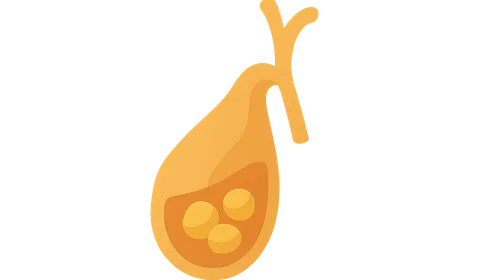 Cholelithiasis and Cholecystitis