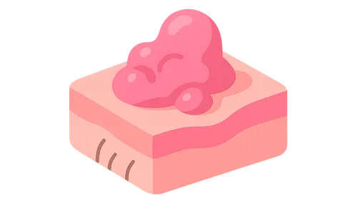 Non-melanoma skin cancers