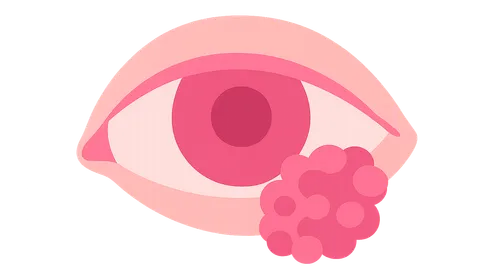 Benign Tumors of Conjunctiva