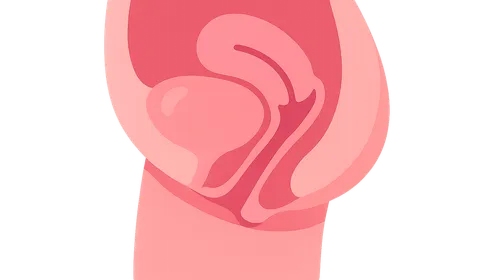 Cystocele and Urethrocele