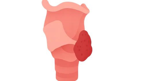 Hypopharyngeal Carcinoma