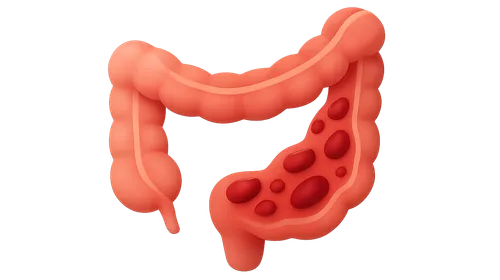 Ulcerative colitis pathophysiology