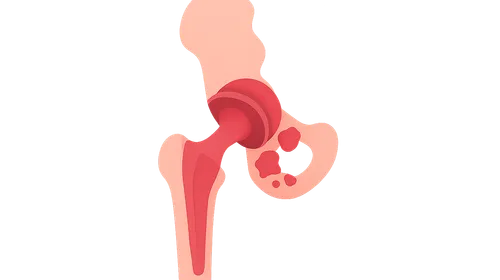 Prosthetic Joint Infections