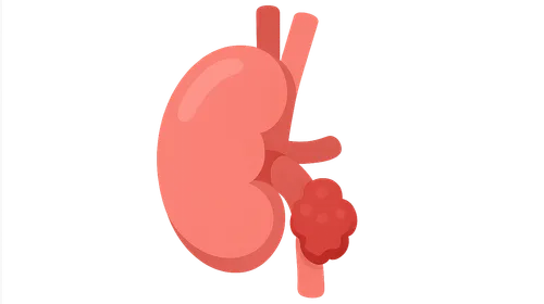 Renal Cell Carcinoma