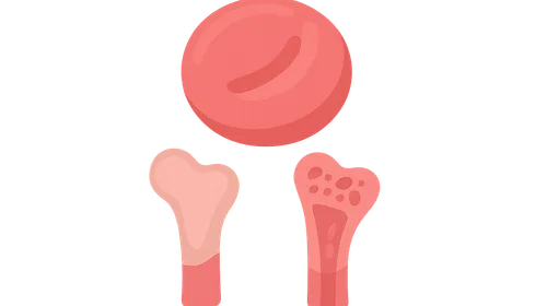 Anemia of chronic disease