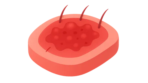 Acute and Chronic Inflammation