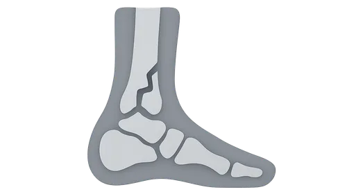 Ankle Fractures