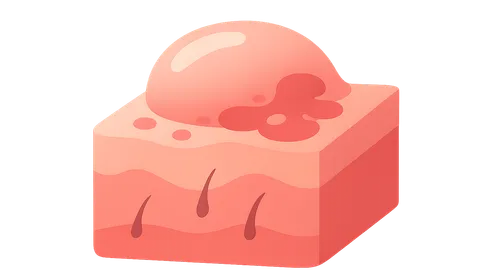 Linear IgA Bullous Dermatosis