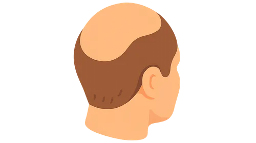 Androgenetic Alopecia