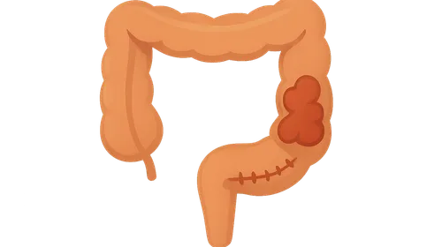 Inflammatory bowel disease surgical management
