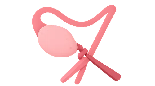 Ovarian torsion management