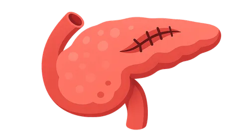 Complications of Pancreatic Surgery