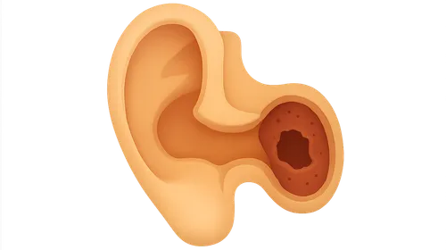 Chronic Otitis Media