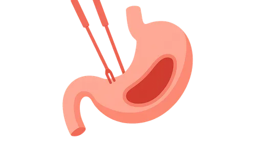 Conversion to open surgery criteria