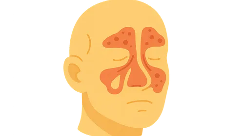 Acute Rhinosinusitis