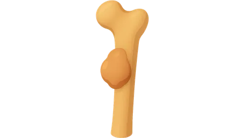 Benign Bone Tumors