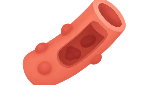 Small vessel vasculitis