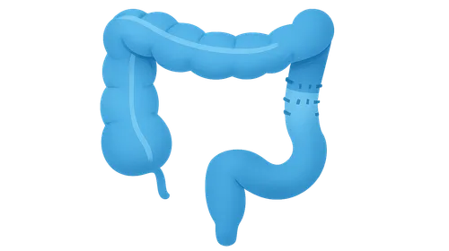 Hirschsprung disease management