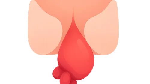 Hemorrhoids
