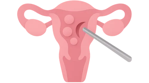 Myomectomy procedures