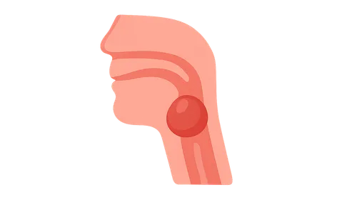 Retropharyngeal Abscess