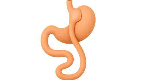 Roux-en-Y Gastric Bypass