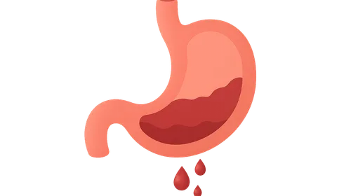 Gastrointestinal Bleeding