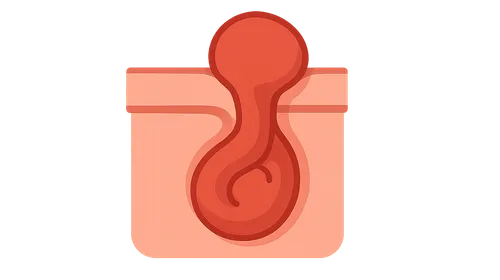 Incarcerated/strangulated hernias