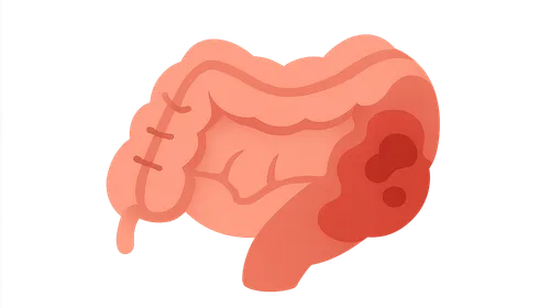 Necrotizing enterocolitis surgical management