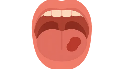 Oral Cavity Lesions