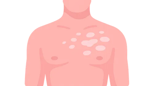 Pityriasis Alba