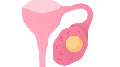 Ovulatory Disorders