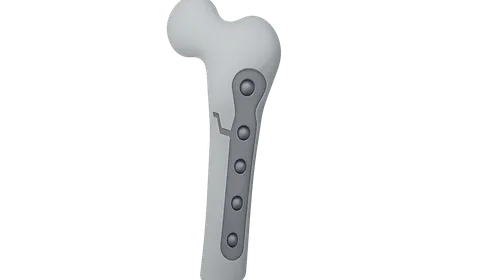 Principles of Internal Fixation