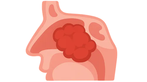 Tumors of the Nose and Paranasal Sinuses