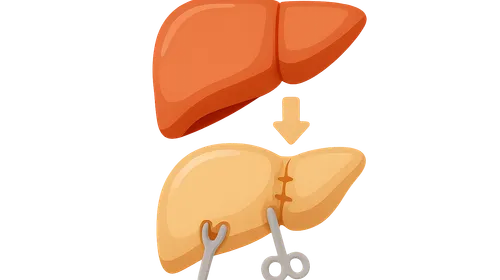 Liver Transplantation
