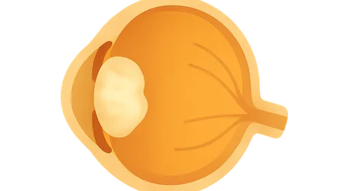 Drug-Induced Cataracts