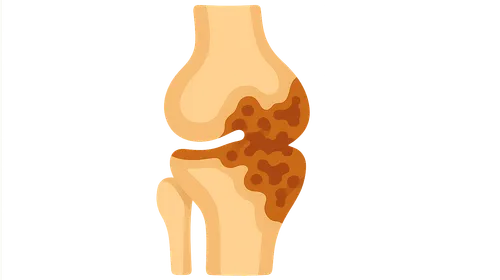 Tuberculosis of Bones and Joints