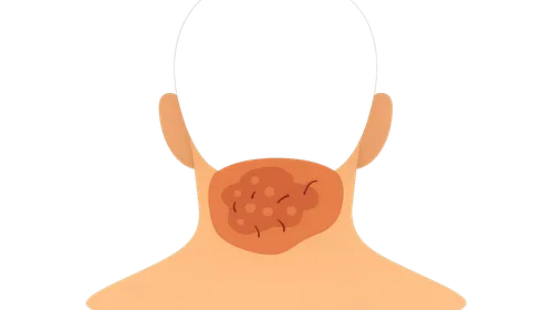 Acne Keloidalis Nuchae