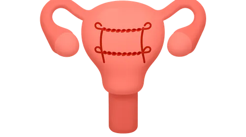 Uterine compression sutures