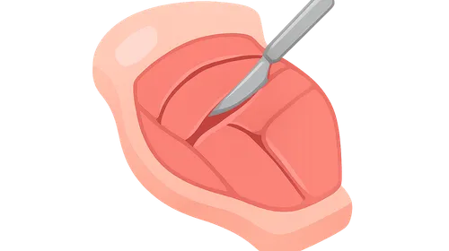 Surgical approaches to fascial compartments