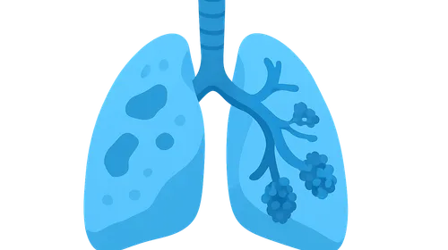 Obstructive lung diseases (emphysema, bronchitis)