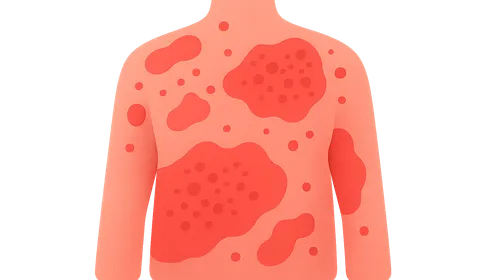 Erythrodermic Psoriasis