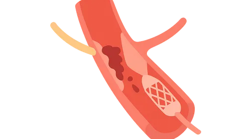 Reperfusion strategies (fibrinolysis vs PCI)