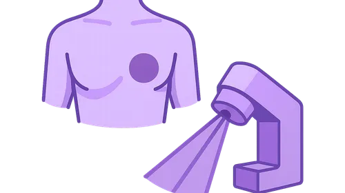 External Beam Radiation Therapy