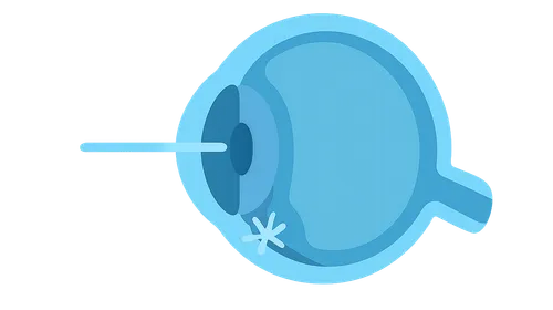 Laser Therapy in Glaucoma