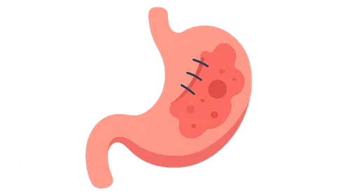 Wound complications (dehiscence, evisceration)