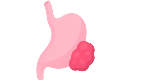 Salivary Gland Tumors